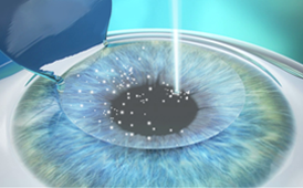 LASIK 100% Laser